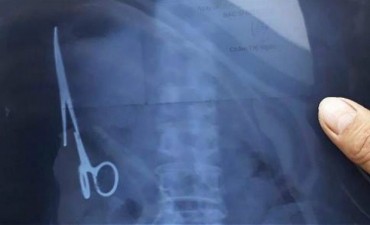 Vivi&oacute; 18 a&ntilde;os con tijeras en el est&oacute;mago