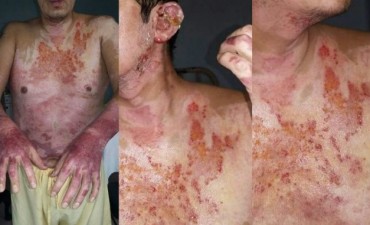 Una mujer prendi&oacute; fuego a su ex novio por celos
