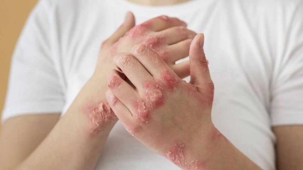 Alarma por el aumento de s&iacute;filis en j&oacute;venes: crecen los casos en la Regi&oacute;n Centro