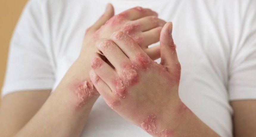 Alarma por el aumento de s&iacute;filis en j&oacute;venes: crecen los casos en la Regi&oacute;n Centro