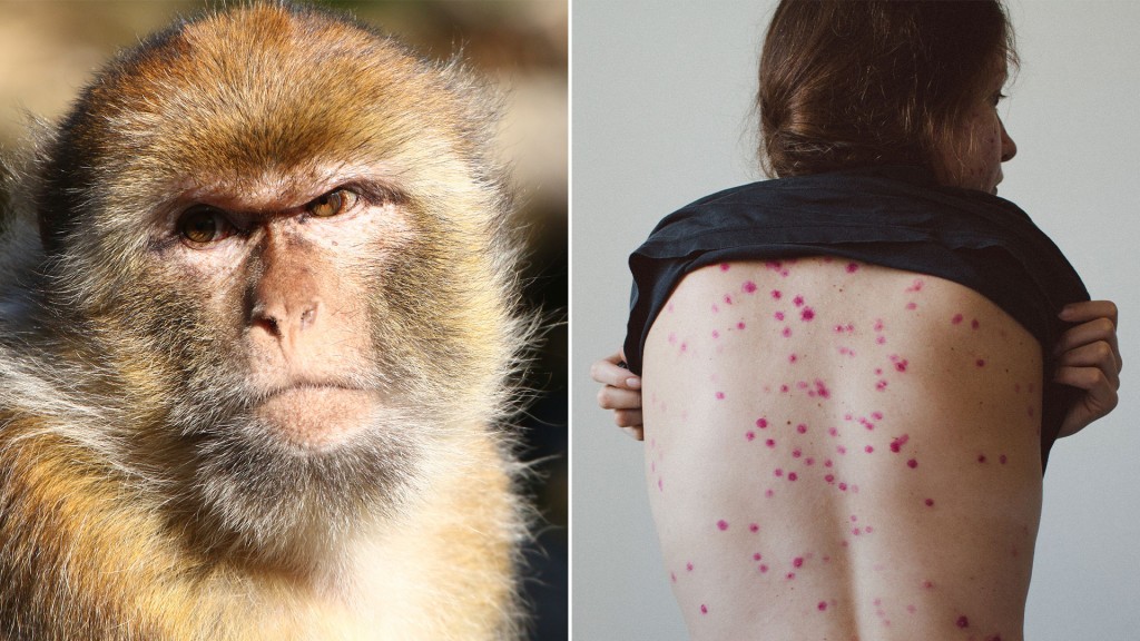 Viruela del mono: Salud reportó caso sospechoso en el país