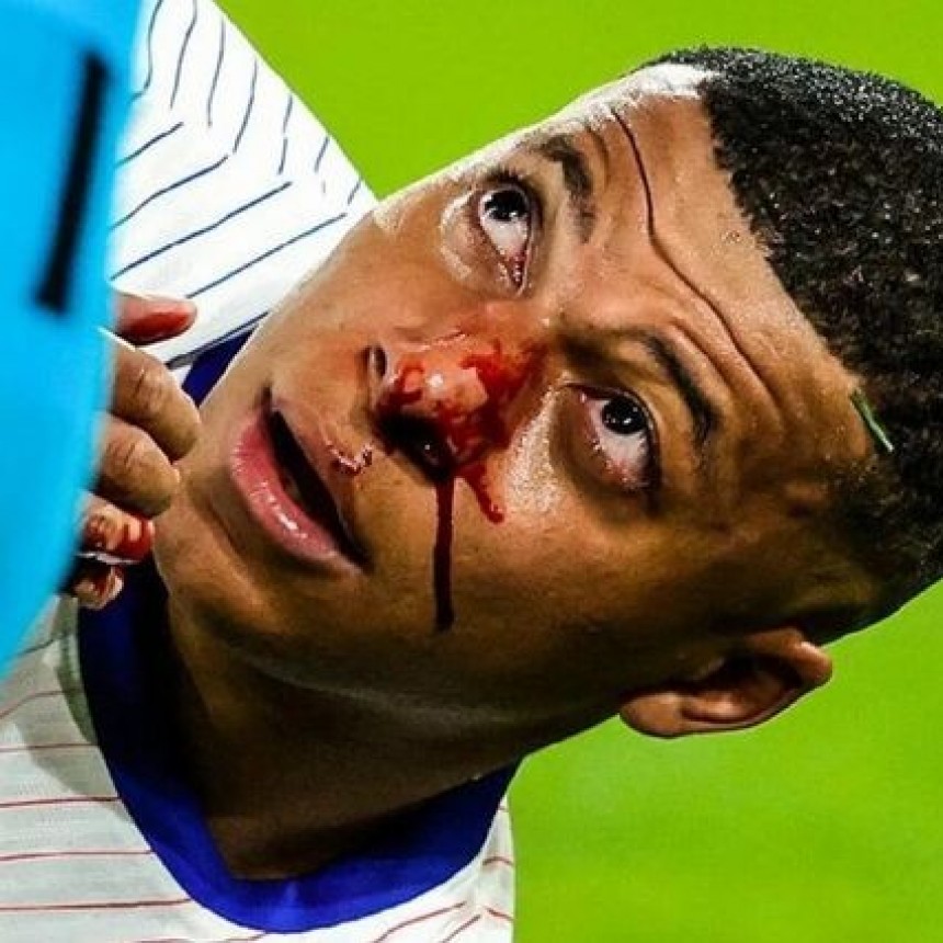 Mbapp&eacute; se fractur&oacute; la nariz, pero no ser&aacute; operado: &iquest;Cu&aacute;ndo vuelve a jugar?
