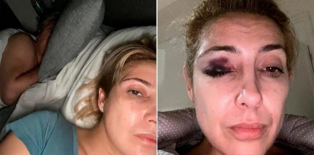 Difundieron nuevas fotografías de Fabiola Yáñez con heridas en su rostro