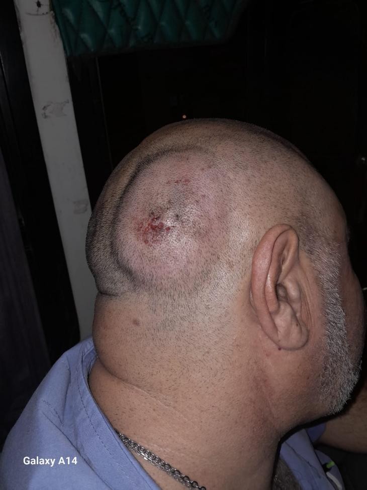 Chofer de la Línea 16 fue brutalmente agredido con una piedra